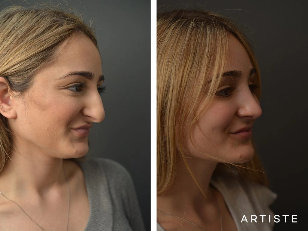  23 Years Old Female Total Nose Rhinoplasty