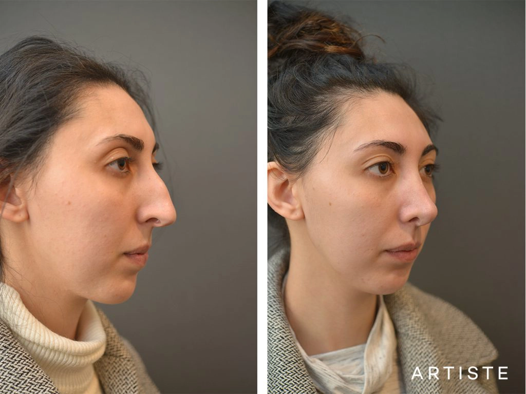 30 Years Old Female Shape (Dorsal Reduction) Nose Rhinoplasty