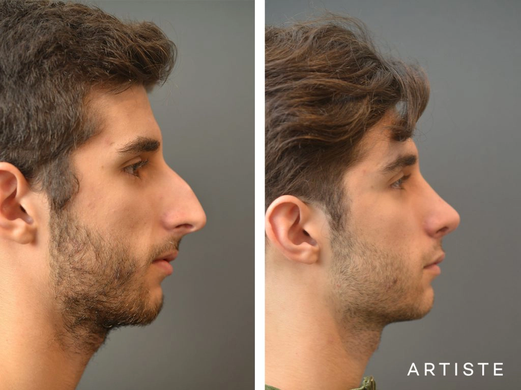 21 Years Old Male Shape (Dorsal Reduction) Nose Rhinoplasty