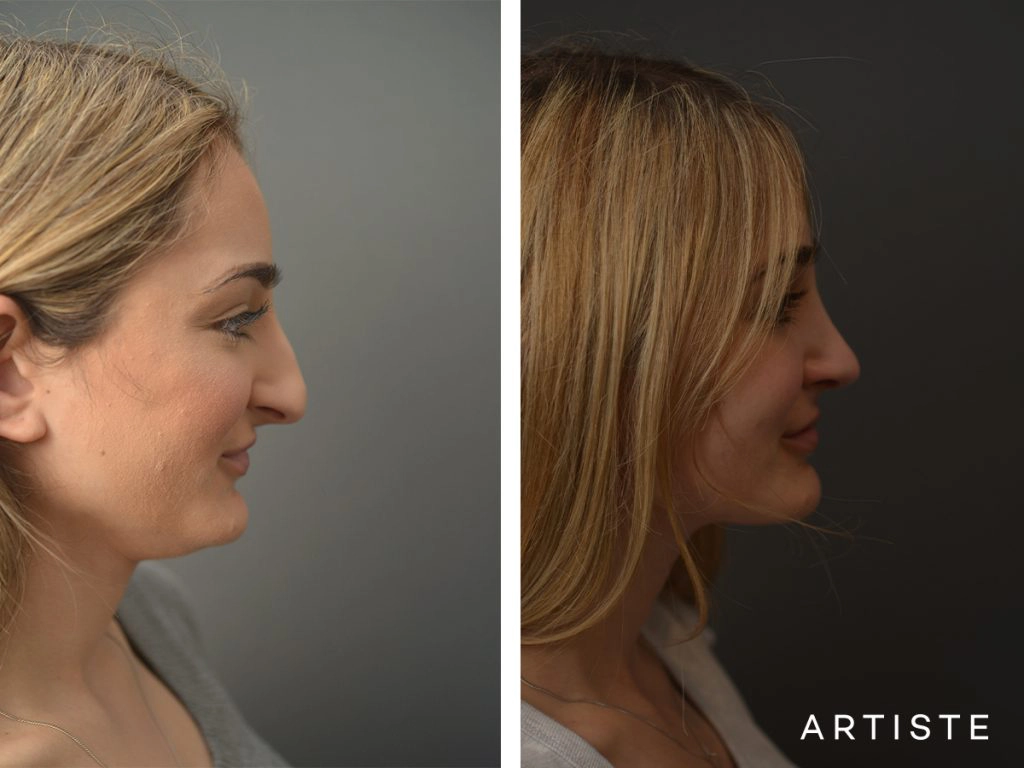  23 Years Old Female Total Nose Rhinoplasty