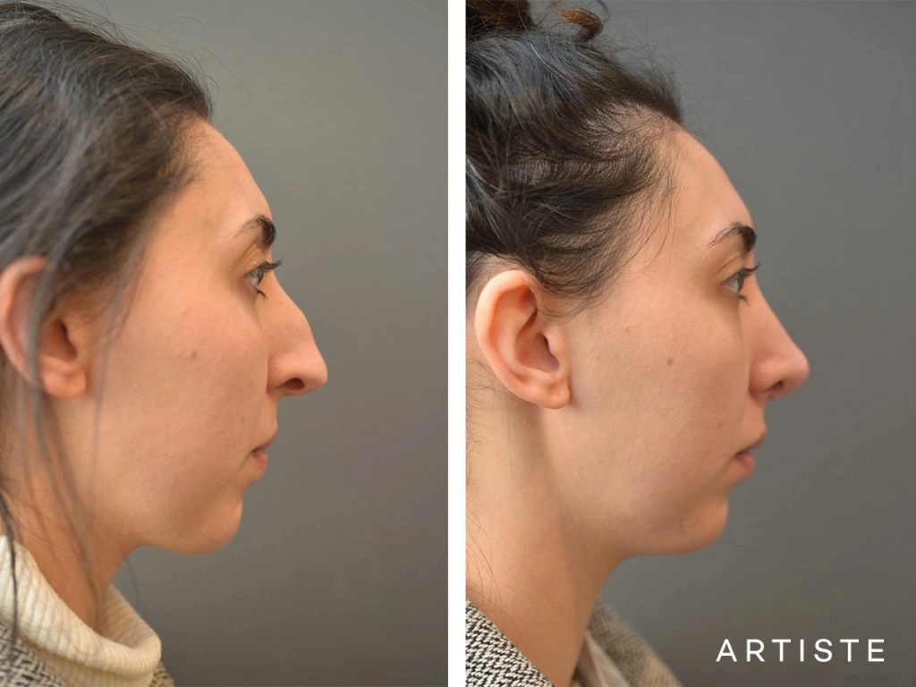 30 Years Old Female Shape (Dorsal Reduction) Nose Rhinoplasty