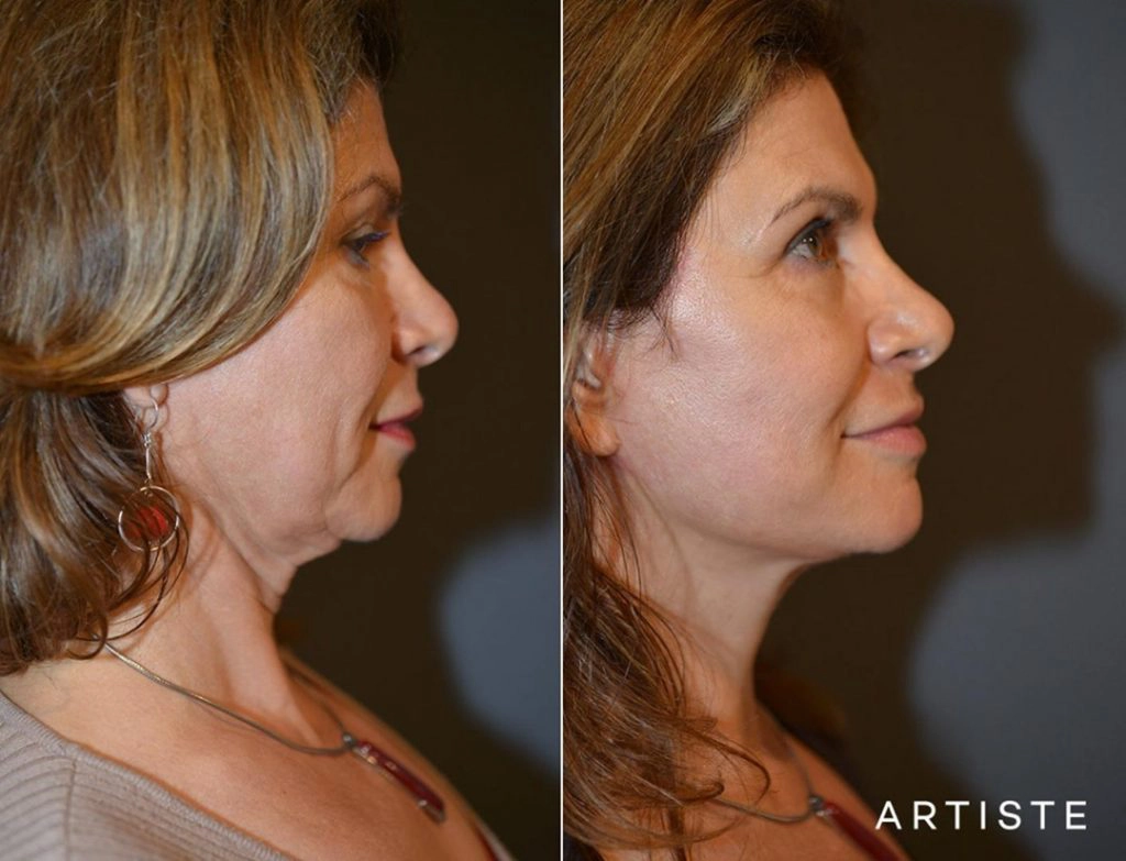 Avoiding Common Facelift Mistakes