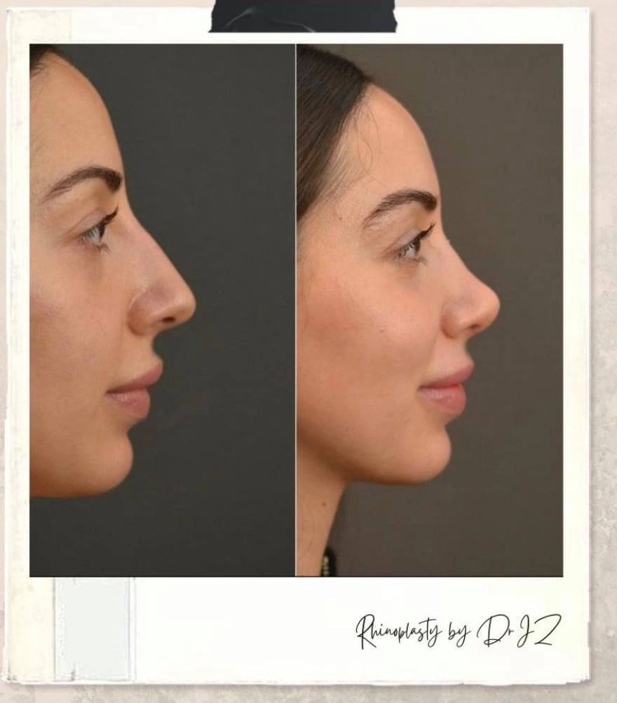 What to Expect During Revision Rhinoplasty