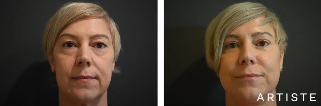 eyelid surgery before and after