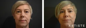 eyelid surgery before and after