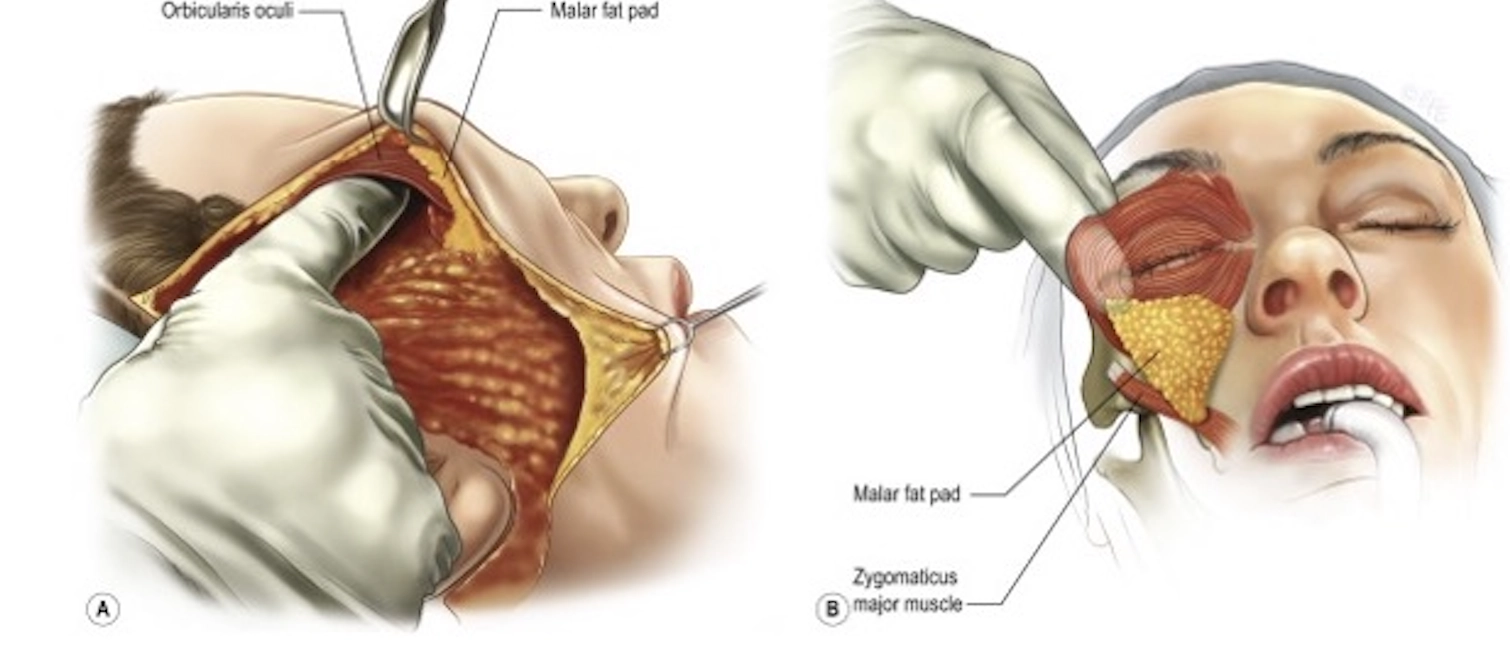 Deep Plane Facelift procedure chart