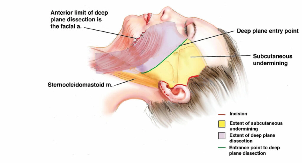 A clinical photo of a Deep Plane Facelift procedure