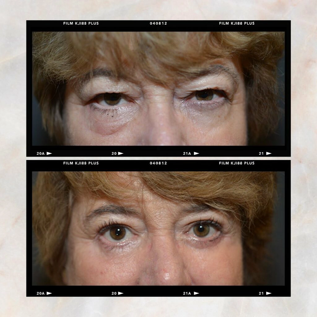 Avoiding Eyelid Surgery Complications