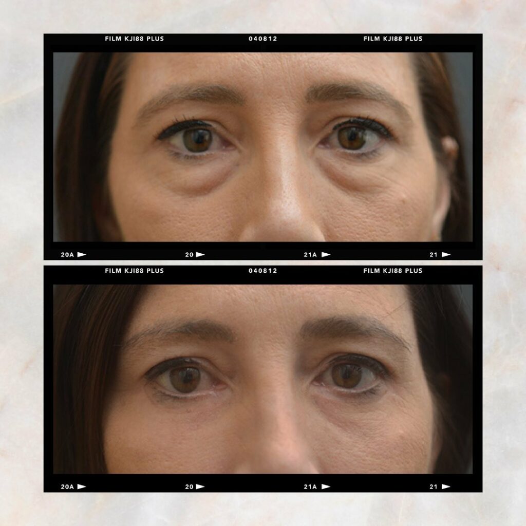 Eyelid Surgery Before and After