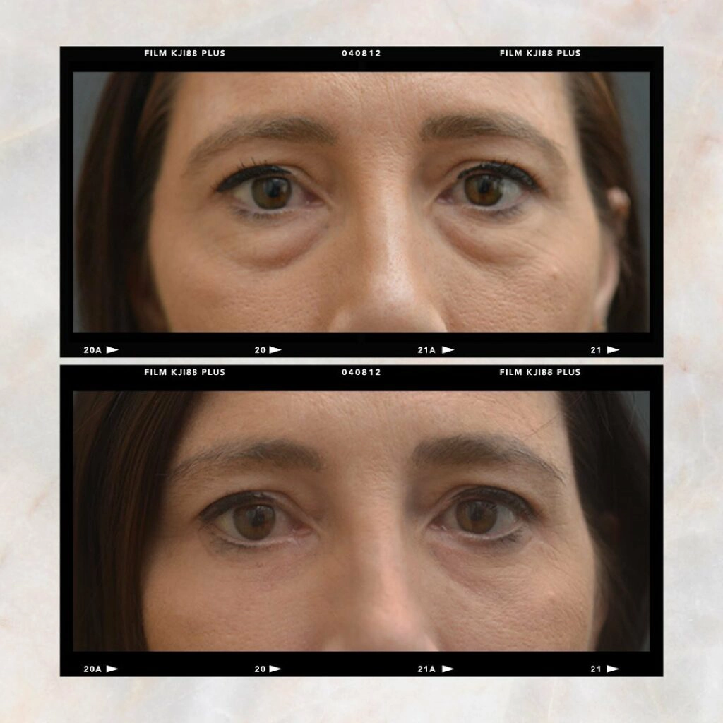Eyelid Surgery Before and After