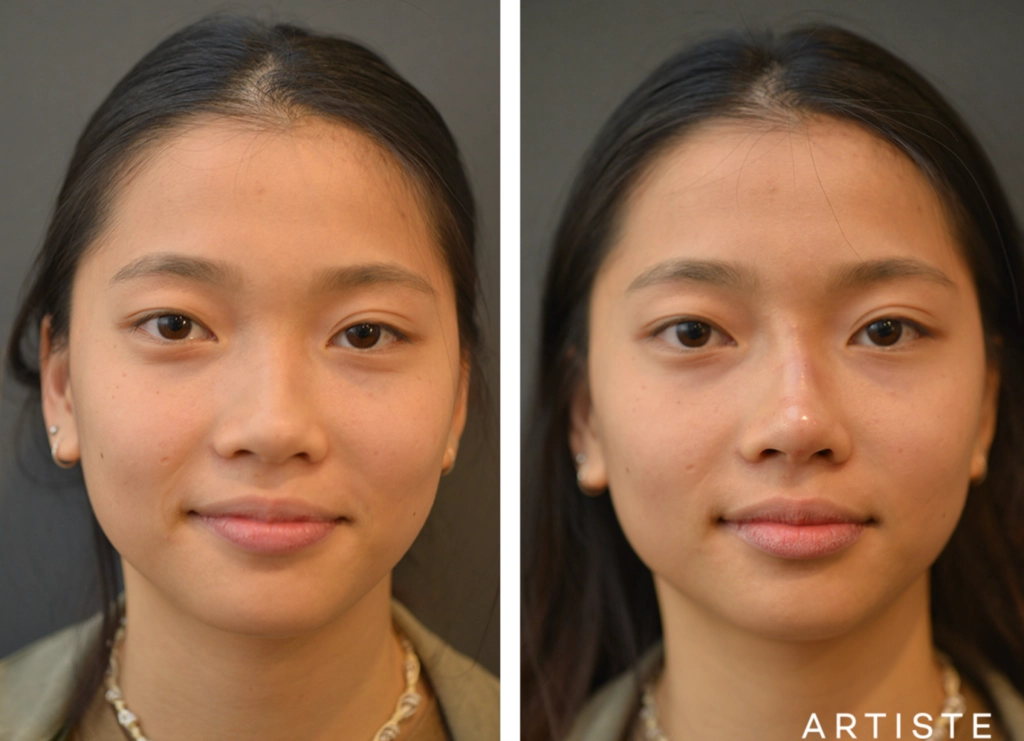 Non Surgical Asian Rhinoplasty Before and After