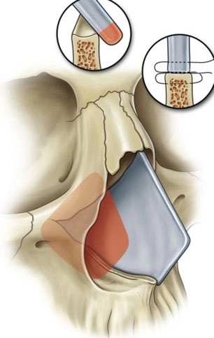 septoplasty