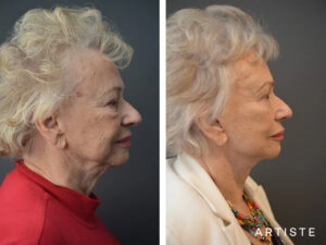 before and after image comparison of a woman who's undergone turkey neck surgery