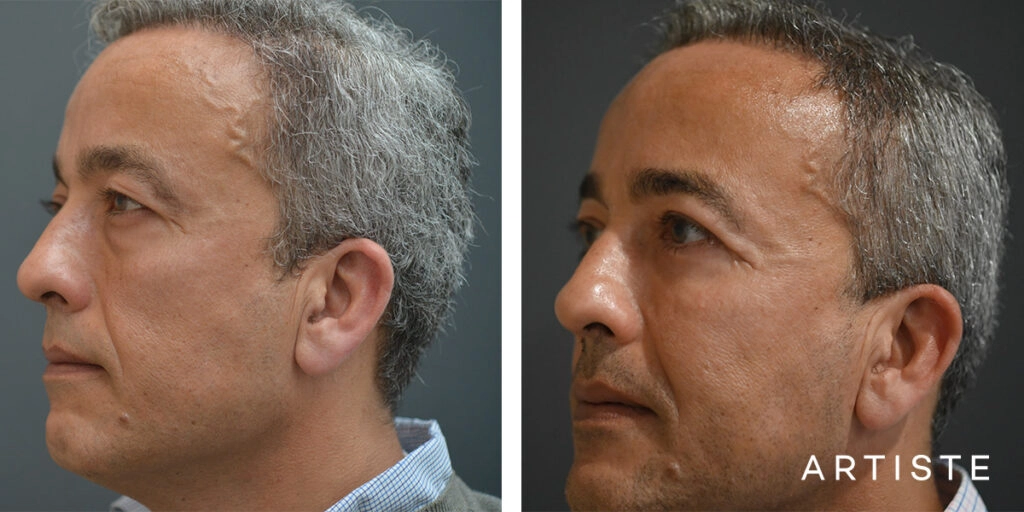 50 Year Old Lower Blepharoplasty