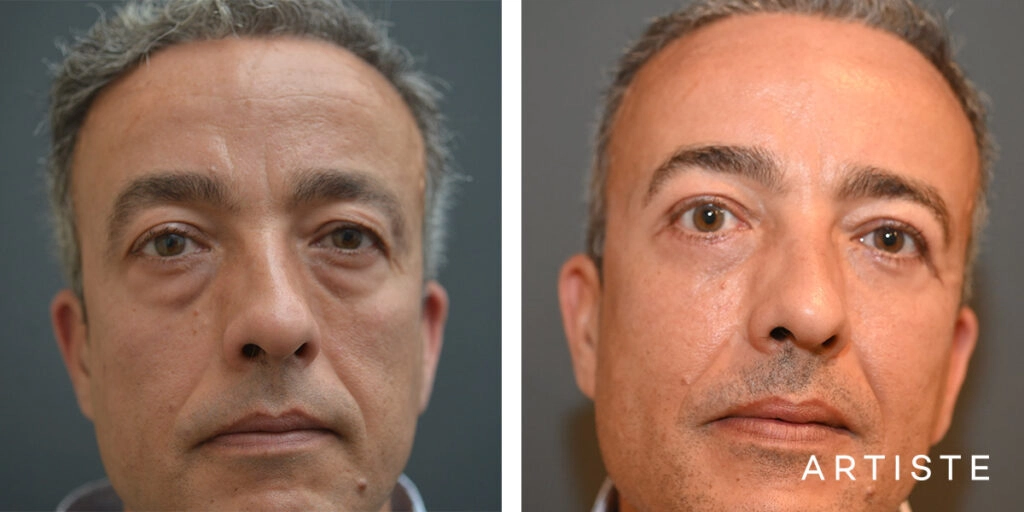 50 Year Old Lower Blepharoplasty