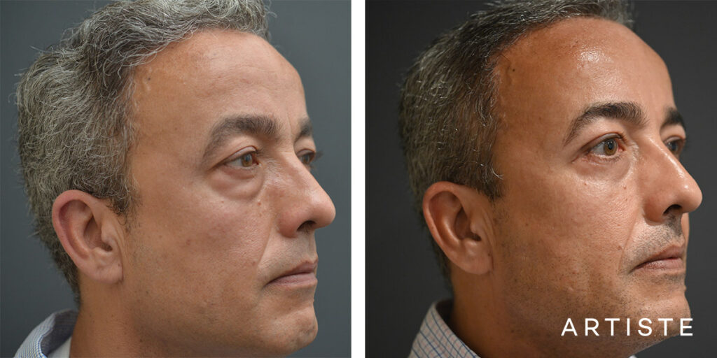 50 Year Old Lower Blepharoplasty