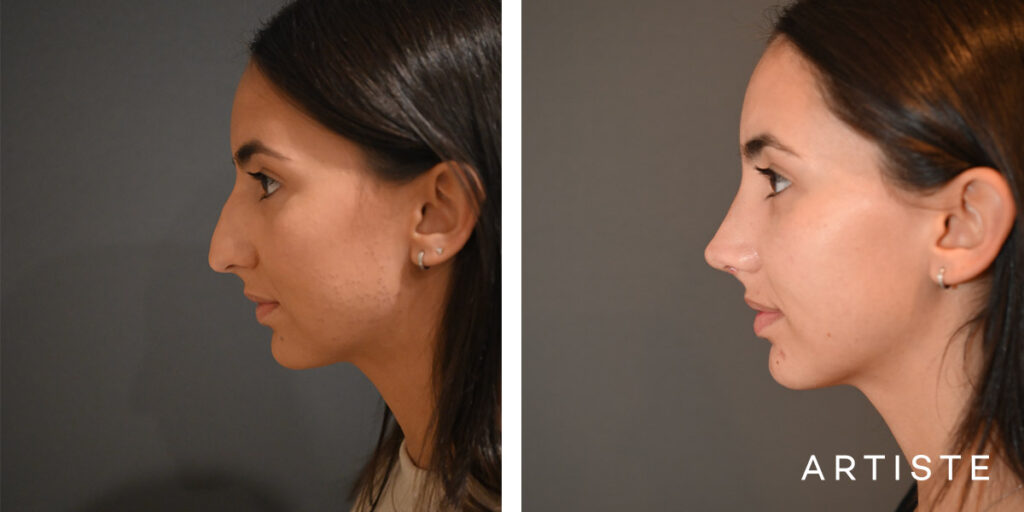 25 Year Old Profile Rhinoplasty