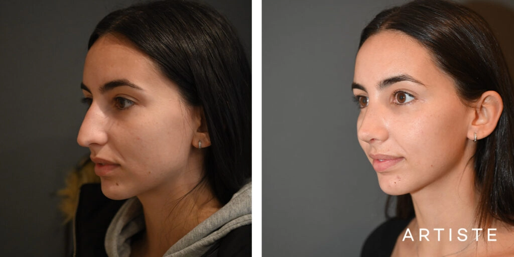 25 Year Old Profile Rhinoplasty