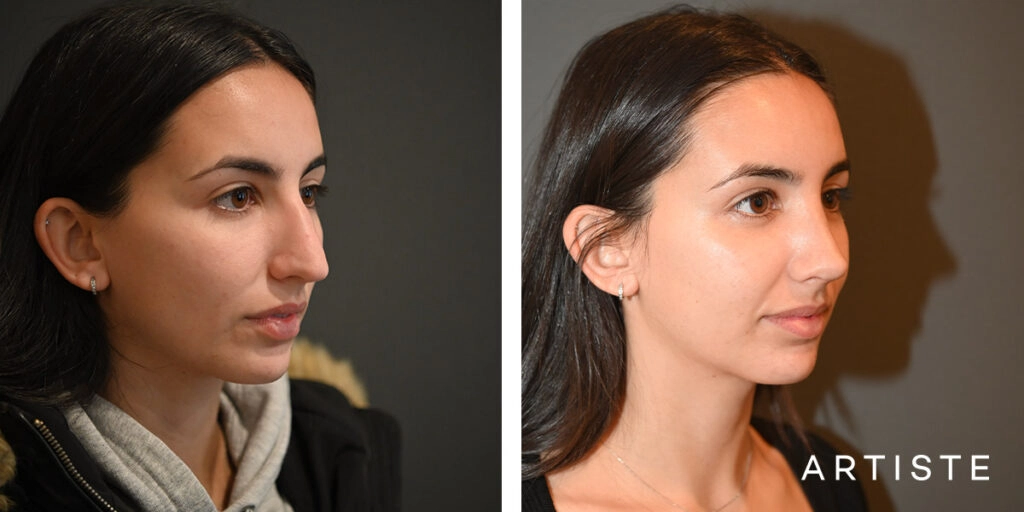 25 Year Old Profile Rhinoplasty