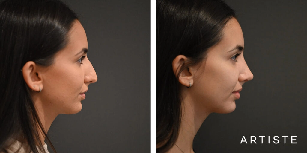 25 Year Old Profile Rhinoplasty