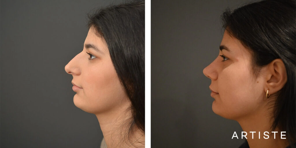 21 Year Old Profile Rhinoplasty