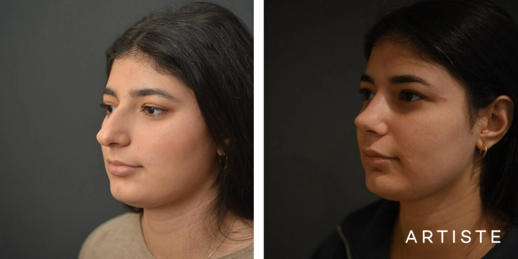 21 Year Old Profile Rhinoplasty