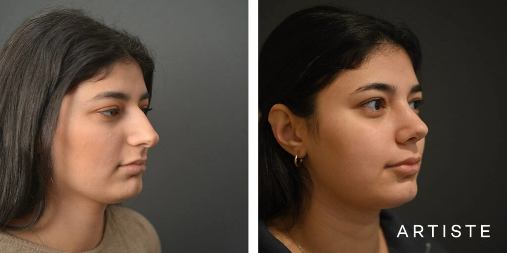 21 Year Old Profile Rhinoplasty