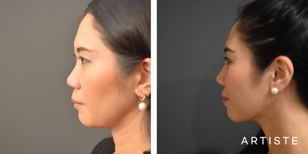 30 Years Old: Rib Graft Augmentation Rhinoplasty and Upper and Lower Eyelid Blepharoplasty