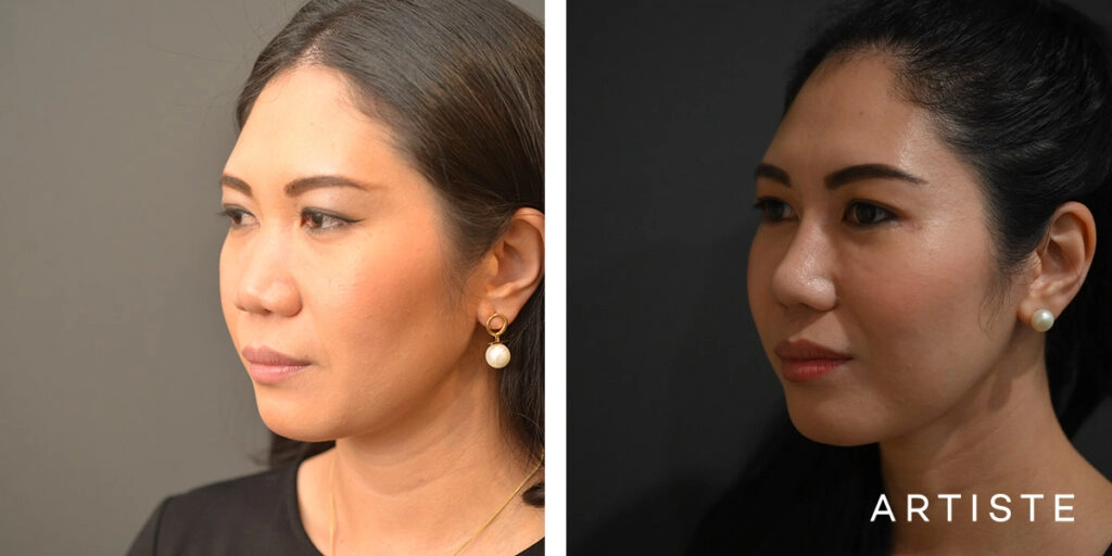 30 Years Old: Rib Graft Augmentation Rhinoplasty and Upper and Lower Eyelid Blepharoplasty