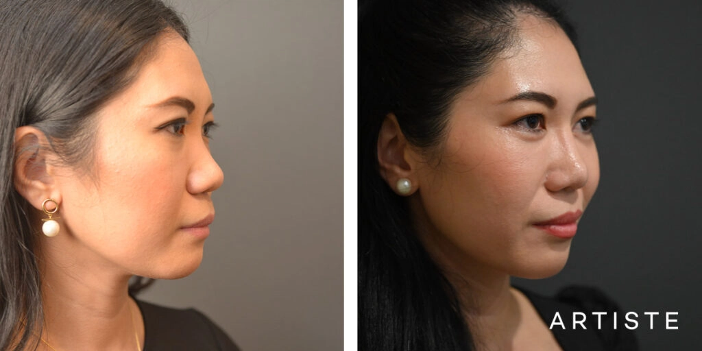 30 Years Old: Rib Graft Augmentation Rhinoplasty and Upper and Lower Eyelid Blepharoplasty