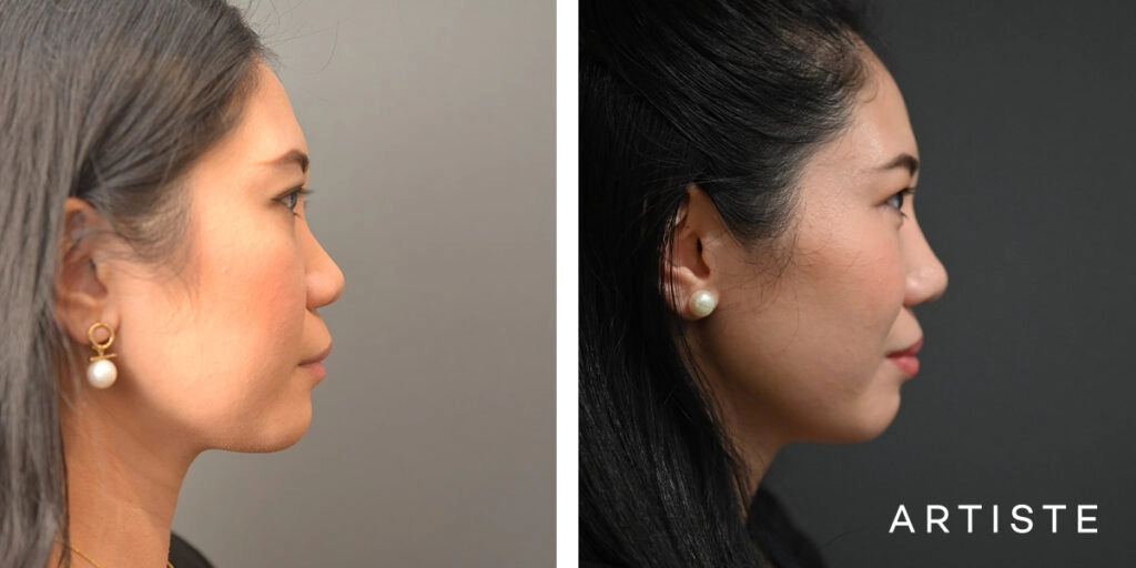30 Years Old: Rib Graft Augmentation Rhinoplasty and Upper and Lower Eyelid Blepharoplasty