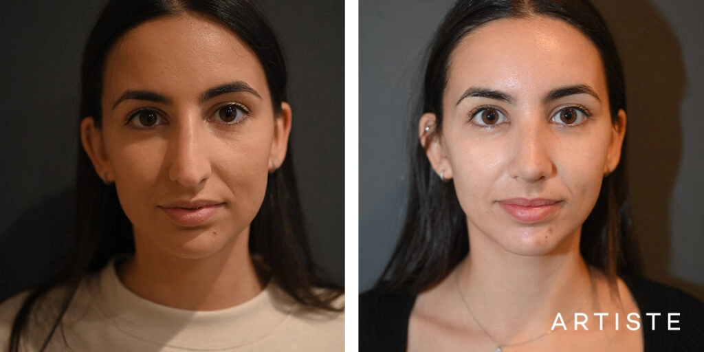 25 Year Old Profile Rhinoplasty