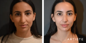 What is the right age for a nose job surgery?