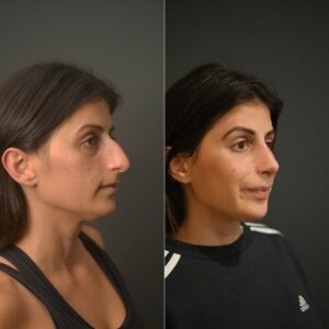 How to Prepare for a Rhinoplasty Surgery