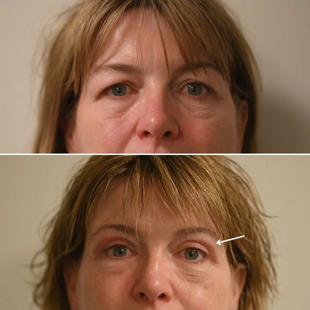 Sagging Eyelids: Causes and Treatments