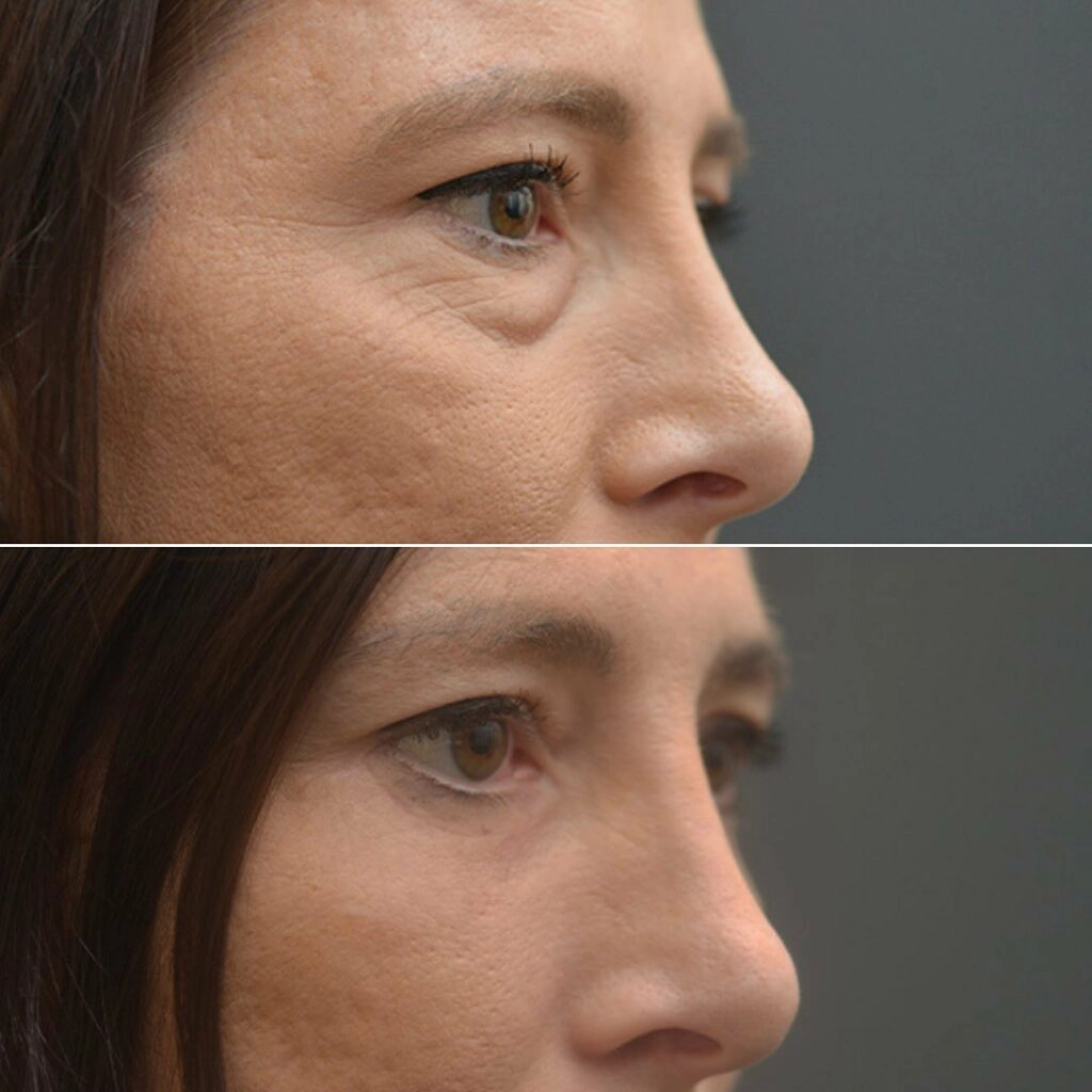 How eyelid surgery helps you look younger