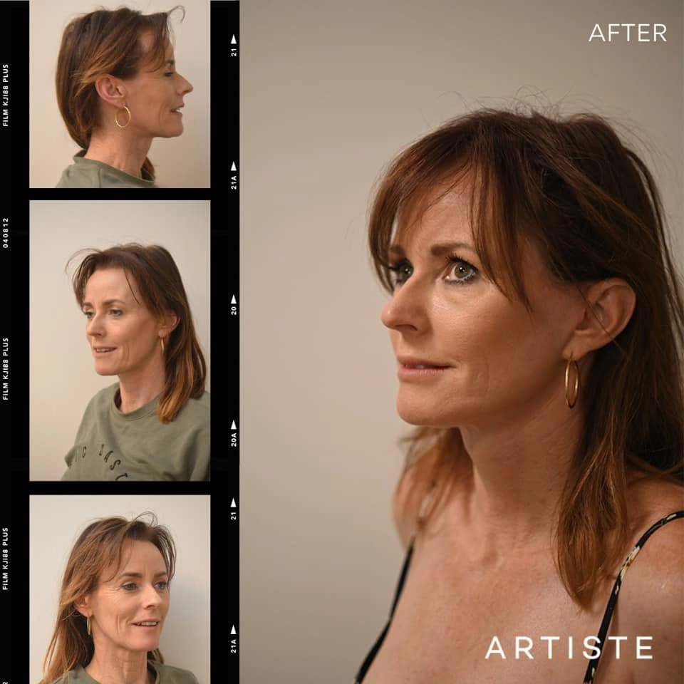 Signature Facelift transformations, which included a Deep Plane Facelift and Structural Fat Transfer & Grafting, to sculpt a natural and beautiful result in one of our younger Facelift patients