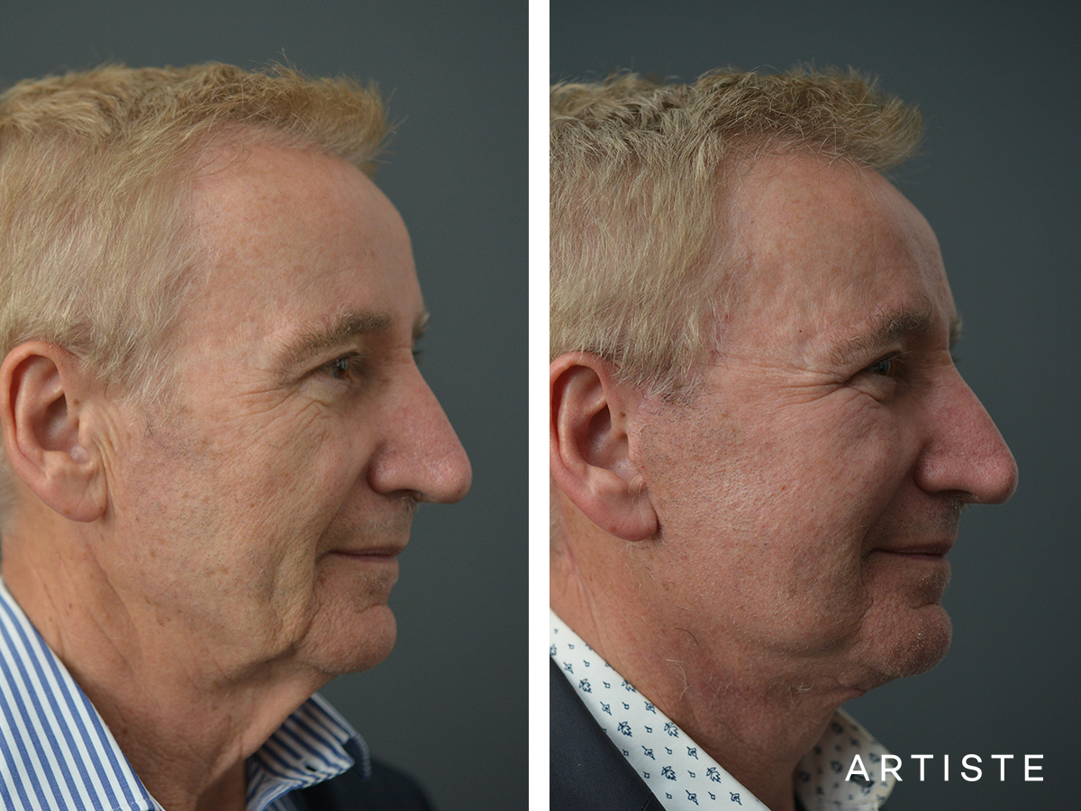 Can Deep Plane Facelift Get Rid Of Jowls Artiste Plastic Surgery