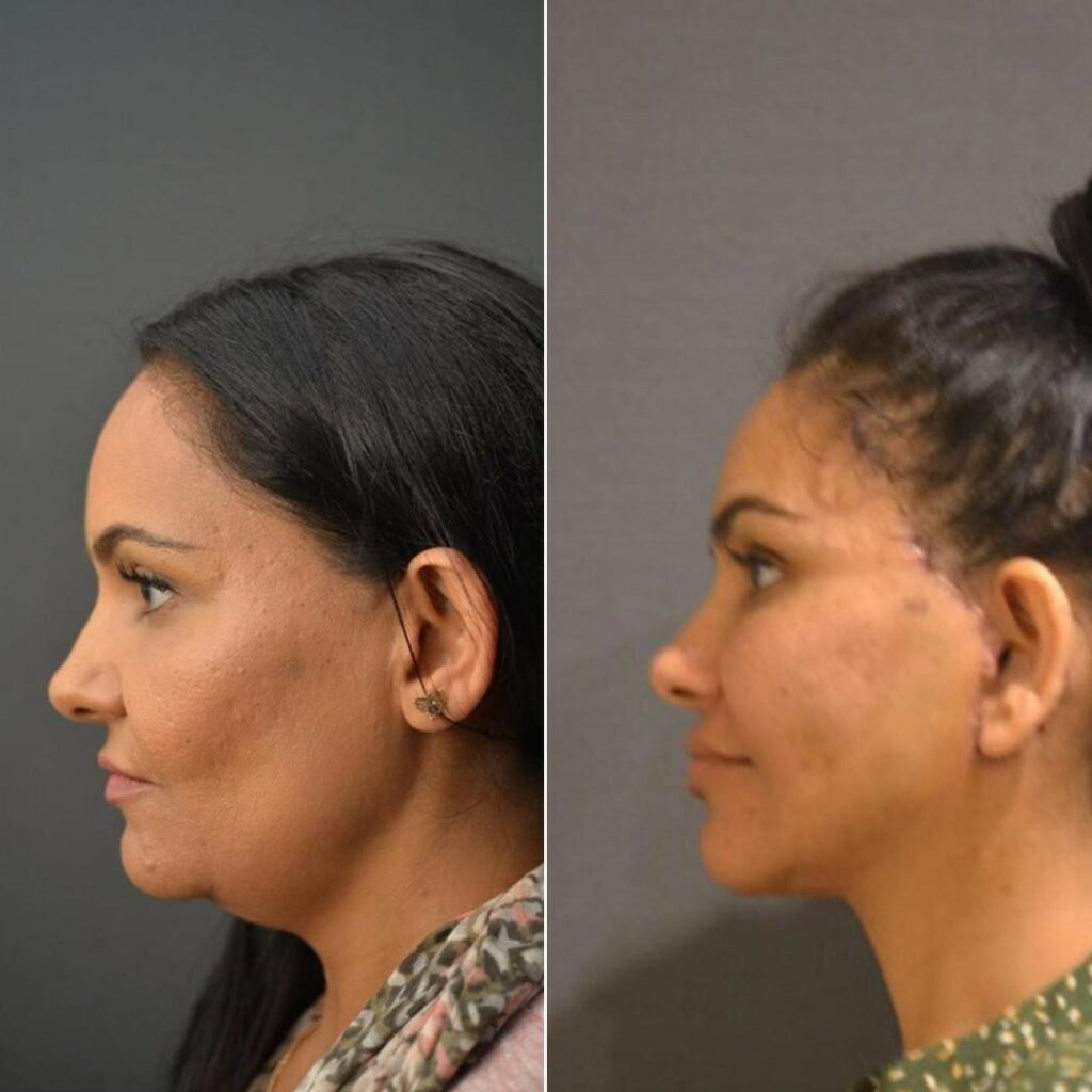 ponytail-facelift