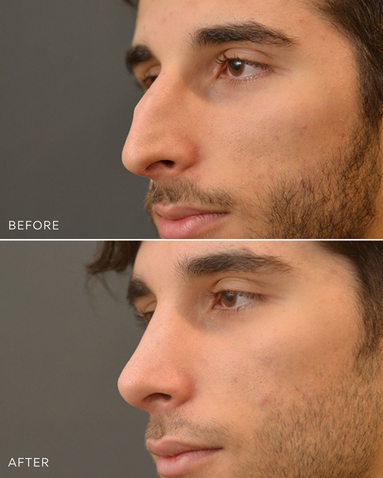 Rhinoplasty Results Over the Years Artiste Plastic Surgery