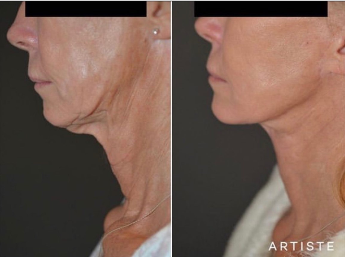 How is a neck lift surgery done? Artiste Plastic Surgery