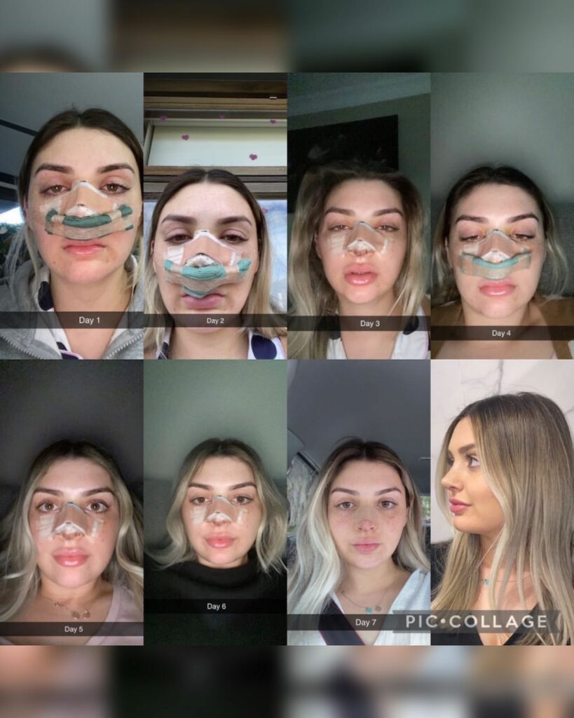 nose-job
