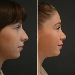 Are You a Good Candidate for a Nose Job | Ariste Plastic Surgery