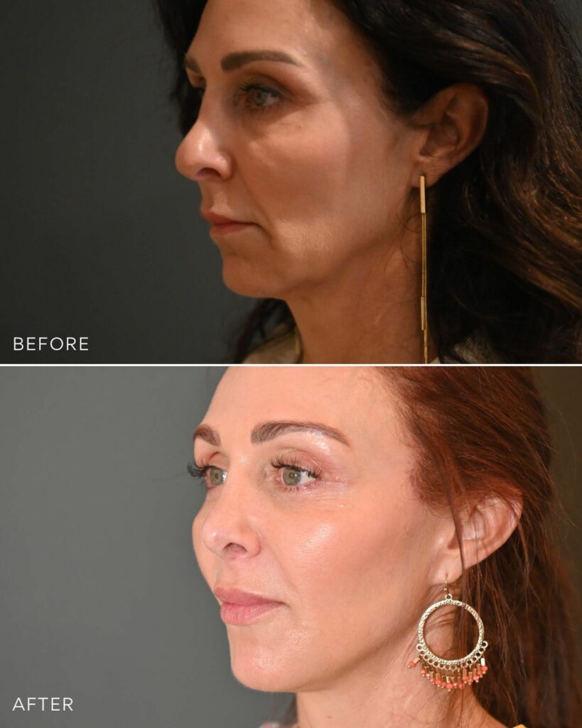 Achieving your desired facelift results