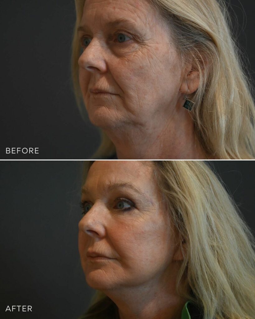 What is an Extended Deep Plane Facelift?