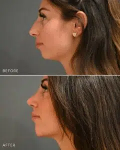 How can rhinoplasty transform your look?