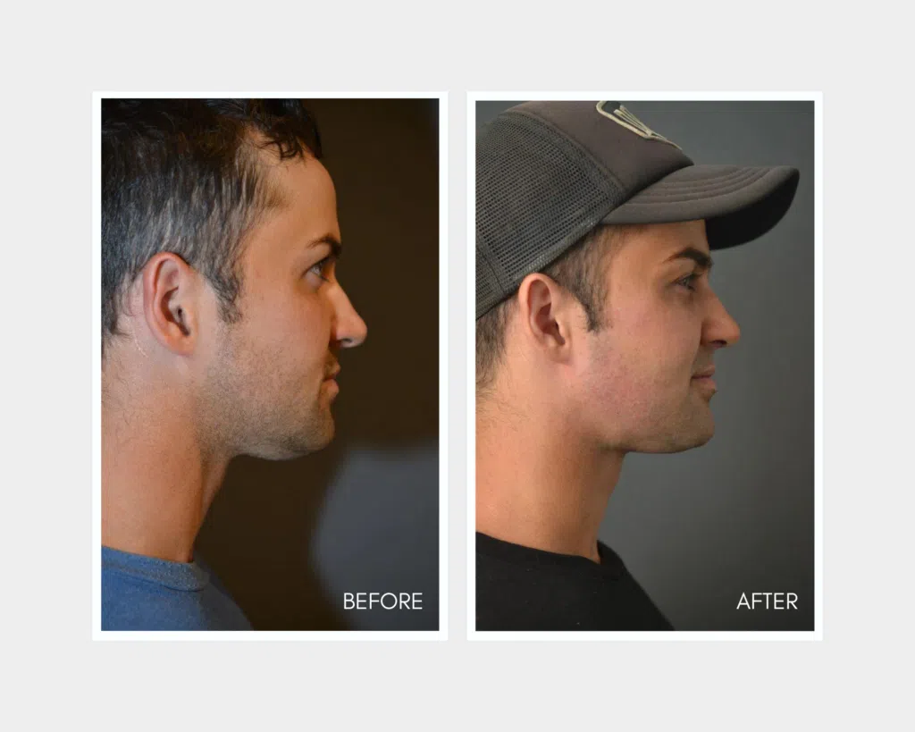 Buccal Fat Removal - Artiste Plastic Surgery