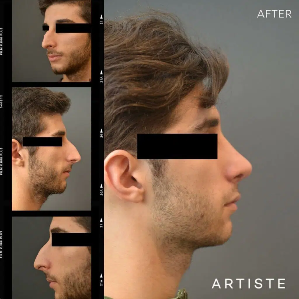 The Latest Uptick in Plastic Surgery: Procedures for Men