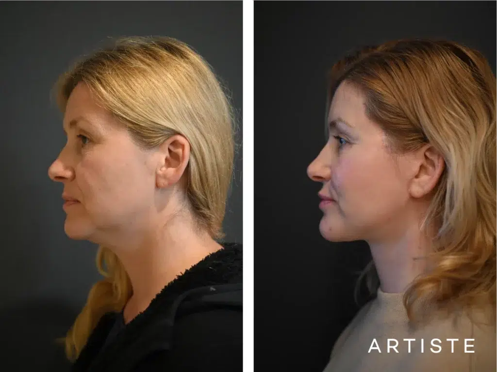 47 Years Old: Deep Plane Face And Neck Lift