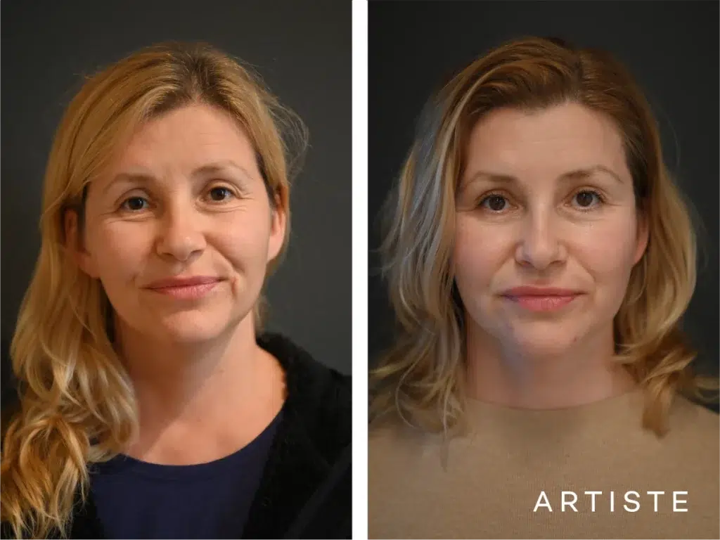 47 Years Old: Deep Plane Face And Neck Lift